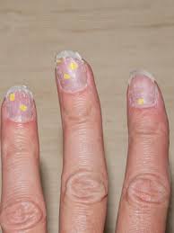 yellow spots on nails can signal