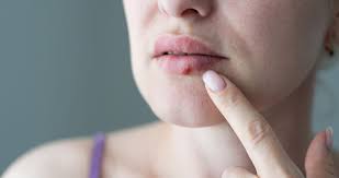 cold sores types symptoms causes