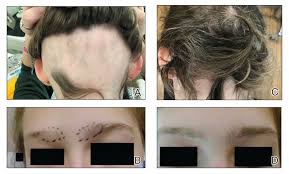 unique treatment for alopecia areata