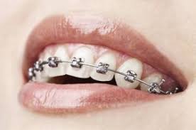 However, maintaining excellent oral hygiene and having regular dental checkups can help to keep teeth bright. How To Whiten Teeth With Braces On 2 Of The Best Solutions