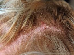 yeast infection on scalp expert review