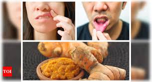 turmeric helps in treating mouth ulcers