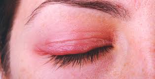 soothe an inflamed eyelid