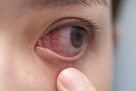 herpes eye infections prevention and