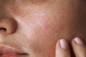 dry skin on face symptoms causes and