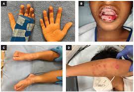 rash characteristics of paediatric