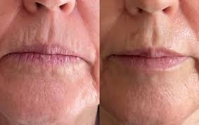 non surgical face and lip line