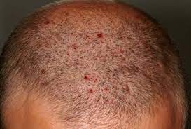 scalp rash itch relief and main causes
