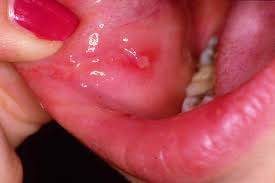 aphthous stomais canker sores