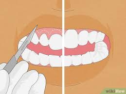 to straighten your teeth without braces