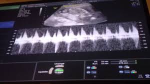 Baby Boys Heartbeat At 16 Weeks