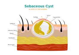 sebaceous cyst carpal tunnel surgery