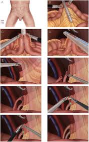The proximal end of the segment is closed, forming a pouch, and the ends of the ureters are sutured to it. Scielo Brasil Laparoscopic Radical Cystectomy With Intracorporeal Ileal Conduit One Center Experience And Clinical Outcomes Laparoscopic Radical Cystectomy With Intracorporeal Ileal Conduit One Center Experience And Clinical Outcomes