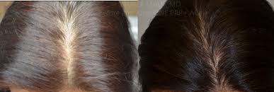 prp acell hair regeneration ac 1 1024x345 jpg