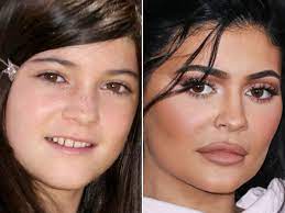 kylie jenner before and after from