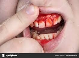 his teeth severe bleeding gums jaw