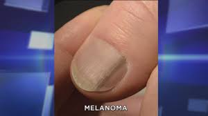 subungual melanoma what you need to