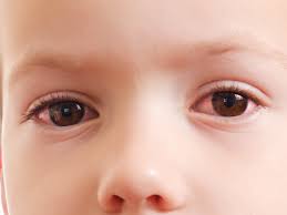 common pediatric eye infections