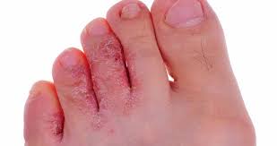 unique cures for athlete s foot foot