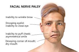 bell s palsy causes treatment