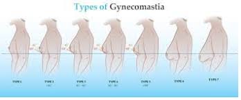 Health About What Is Gynecomastia