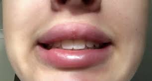 what is this indent in lower lip after