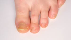 nail dystrophies footmap