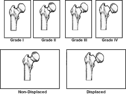 intracapsular hip fractures