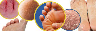 understanding ling feet from causes