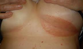 Under Breast Rash From HellDr Appointment MondayItching Is
