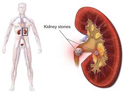 Kumar Ujjwal Blogs 9 Best Food For Kidney Stone Removal