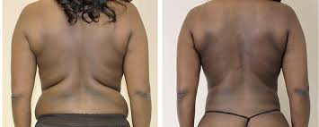 lose weight fast will liposuction help
