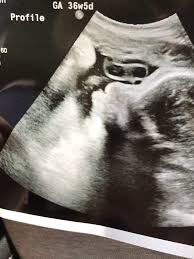 huge lips in ultrasound august 2018