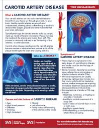 Headaches and dizziness learn to differentiate between common. Carotid Artery Disease Society For Vascular Surgery