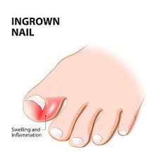 ingrown nails