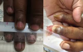 nail disorders skinspecialist com my