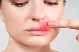 what causes cold sores how to treat