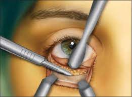 transconjunctival approach to the