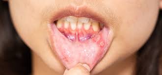 mouth ulcer treatment in chennai