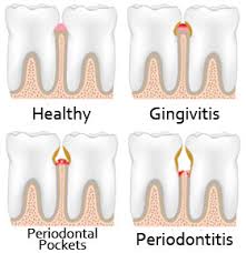bleeding gums may indicate periodontal