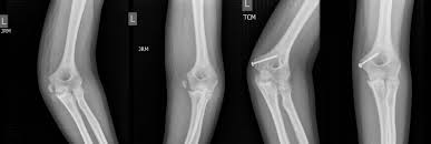 The medial epicondyle of the humerus does not usually begin to ossify before the age of four or five years and, hence is not seen on radiograph of young children. Medial Epicondyle Fractures To Fix Or Not To Fix Sciencedirect