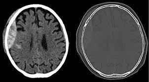 The images show a subdural hematoma. Traumatic Brain Injury Tbi Epidural Hematoma Extradural Haematoma