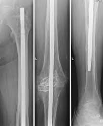 knee arthrodesis with an intramedullary