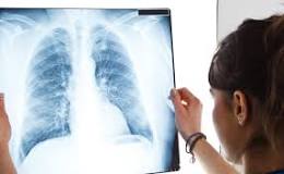 akciğer-kanseri-belirtileri-nelerdir