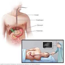 These send information about how our site is used to symptoms of indigestion, such as feeling bloated. Pancreatic Cancer Diagnosis And Treatment Mayo Clinic