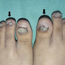 pterygium complicating nail psoriasis