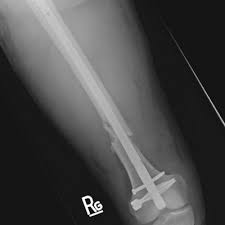 retrograde nail implant 419