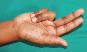 hand eczema an update indian journal