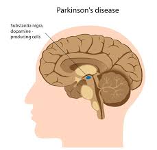 Parkinson disease: MedlinePlus Genetics