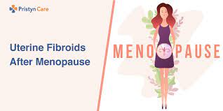 uterine fibroids after menopause